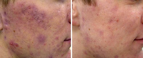 Tratamiento del Acné y corrección de cicatrices causadas por el acné
